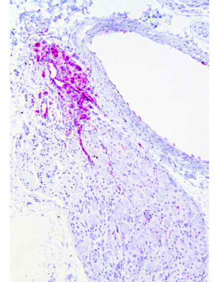 In situ hybridisation for Hif-2 mRNA (pink) in the carotid body, showing high levels of expression, in line with the importance of HIF-2 in oxygen chemosensing by this organ.